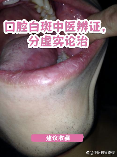 口腔白斑中医辨证,分虚实论治
