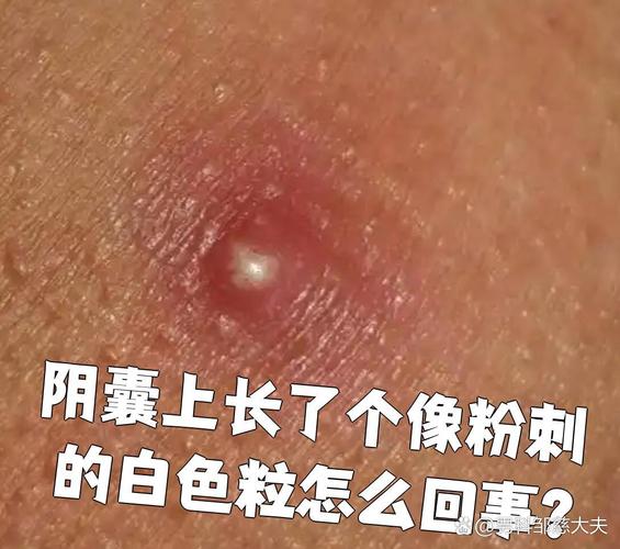 阴囊上长了个像粉刺的白色粒怎么回事?