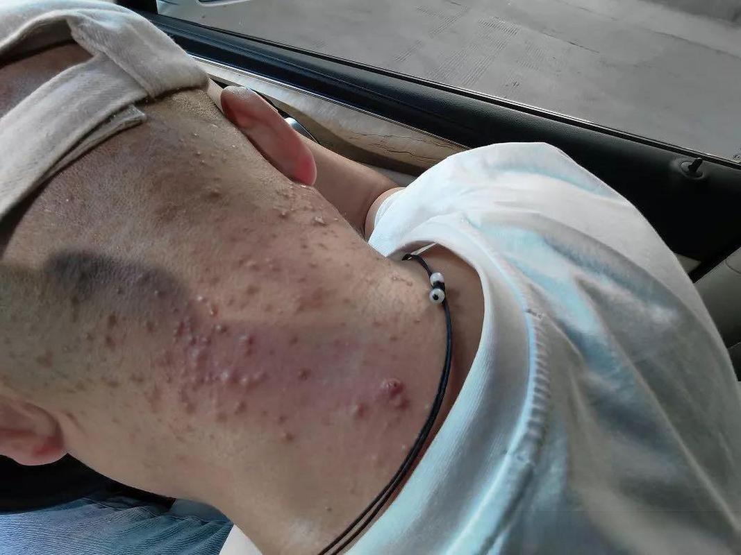 这位24岁的男士发现自己脖子后长了很多小红疙瘩,还