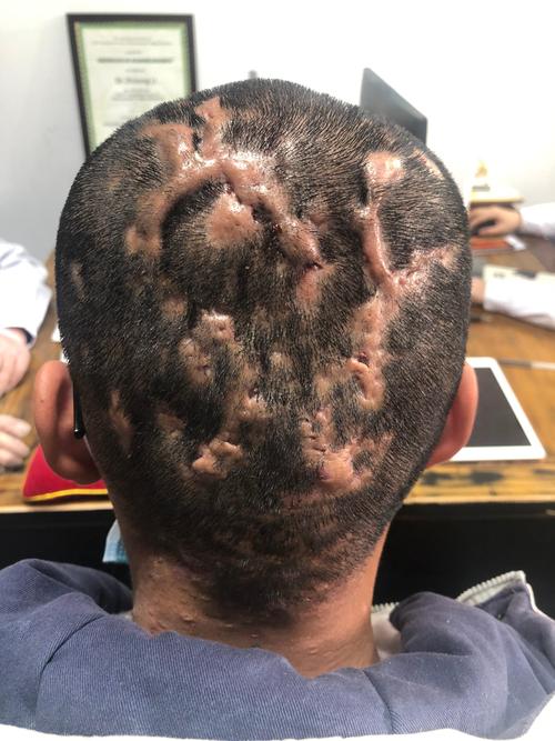 调皮有道李志忠 的想法: 穿掘性毛囊炎,俗称蝼蛄疖亦名曲蟮拱头,蝼蛄