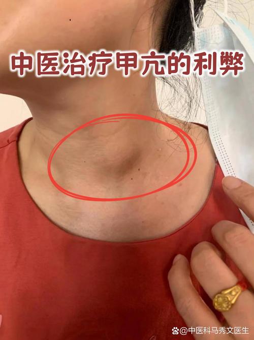 甲状腺功能亢进症让人心慌手抖,中医调理讲究标