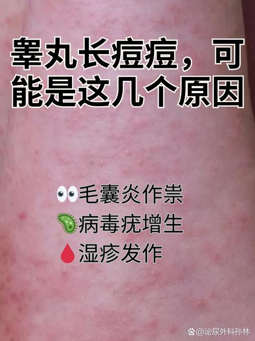 这些痘痘可不是小问题,背后可能隐藏着多种原因