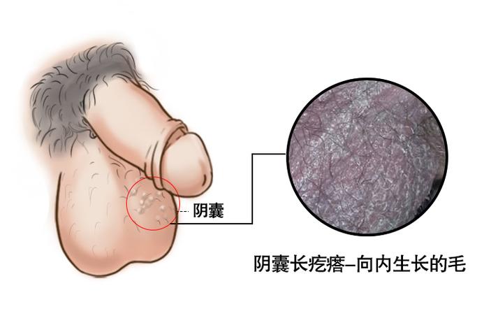 男性阴囊毛囊炎图片疙瘩症状用什么药好